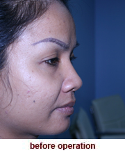 plastic_surgery_augmentation_rhinoplasty